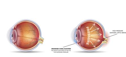 Normal eye vs eye with glaucoma showing the drainage canal blocked and high pressure damages to optic nerve.