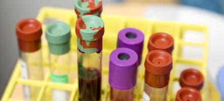 Detect Hepatocellular Carcinoma Up to Seven Years Earlier